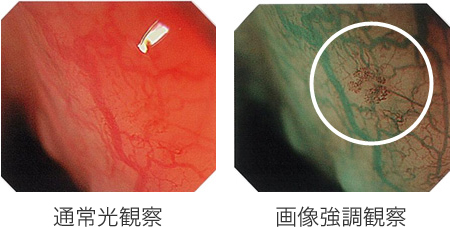 通常光観察・画像強調観察