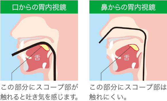 経口内視鏡・経鼻内視鏡検査